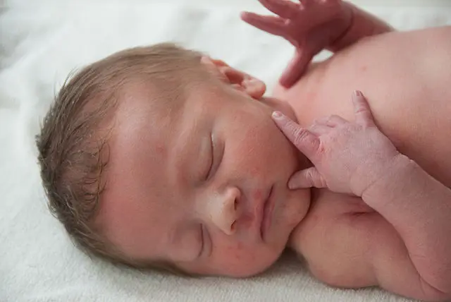 Acne neonatale come riconoscerlo