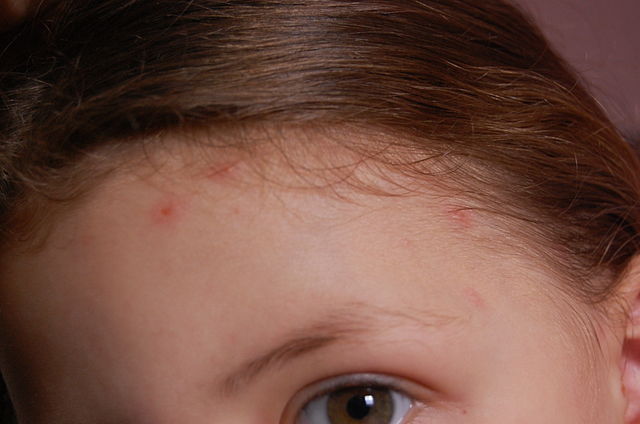 Varicella: come riconoscerla